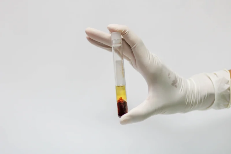 Co je autologní plazma (PRP)