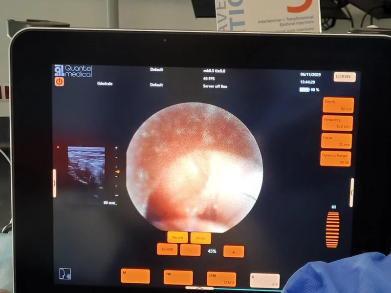 Diagnostická miniartroskopie